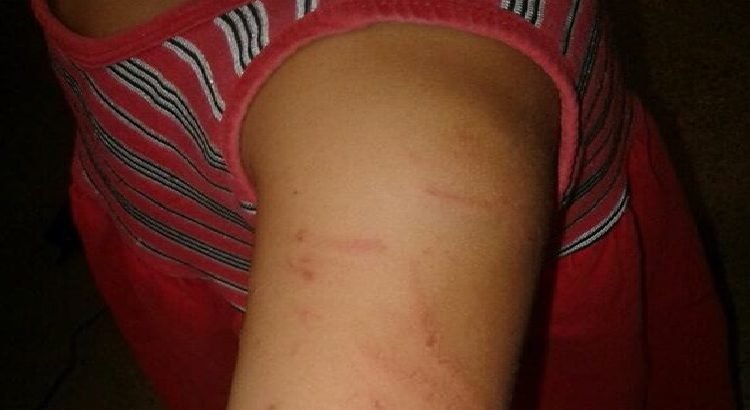 Mãe de criança que sofreu agressão relata não ter certeza se foi professora