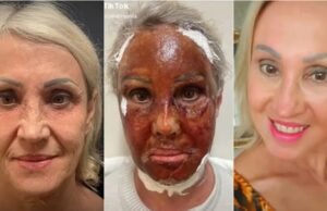 Anvisa proíbe produtos com fenol em procedimento de saúde ou estético