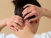 Falta de tratamentos modernos no SUS para dermatite atópica grave em adultos preocupa dermatologistas