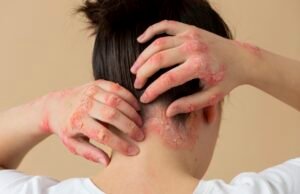 Falta de tratamentos modernos no SUS para dermatite atópica grave em adultos preocupa dermatologistas