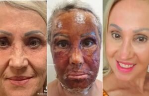 Peeling de fenol: proposta quer regulamentar prática, mas só poderá ser feita em hospitais