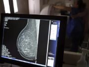 Entidades médicas querem que ANS amplie mamografia de rastreio para mulheres de 40 a 74 anos