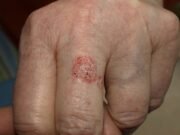 No Dia Mundial da Saúde, cientistas cearenses avançam em pesquisa de creme que previne o câncer