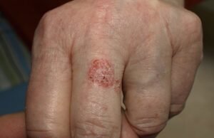 No Dia Mundial da Saúde, cientistas cearenses avançam em pesquisa de creme que previne o câncer