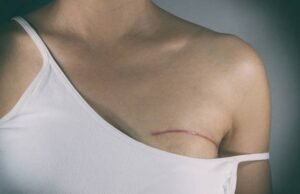 Nova lei garante fisioterapia a pacientes que passam por mastectomia no Brasil