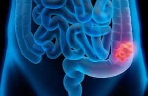 Pacientes com câncer colorretal são diagnosticados em estágio avançado