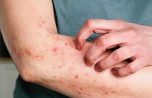 Primeiro caso de Mpox é confirmado no Ceará em 2026