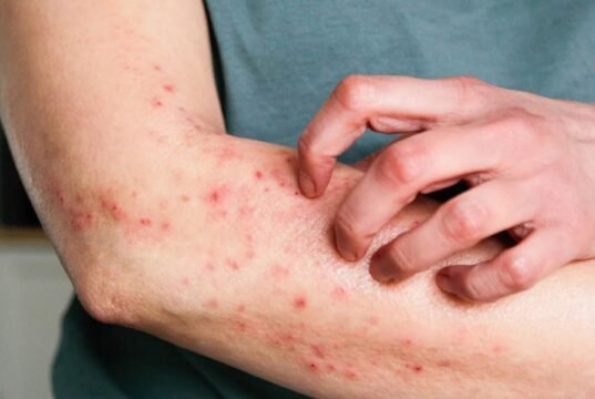 Primeiro caso de Mpox é confirmado no Ceará em 2026