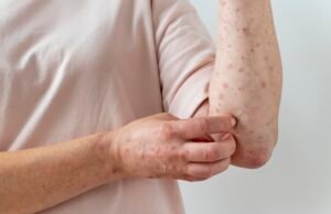 Ceará registra terceiro caso de Mpox em 2026, aponta IntegraSUS