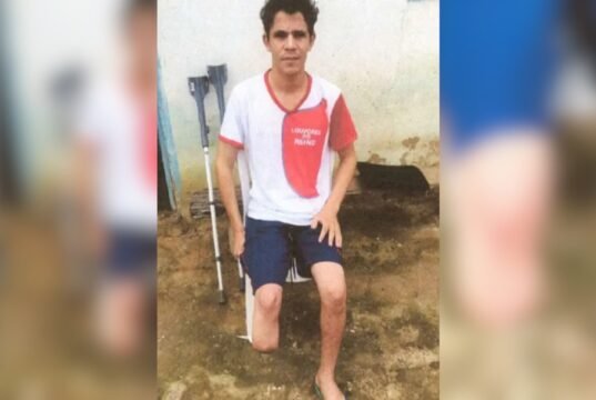 Servidor público simula assalto e amputa o próprio pé para receber R$ 1,5 milhão em indenizações