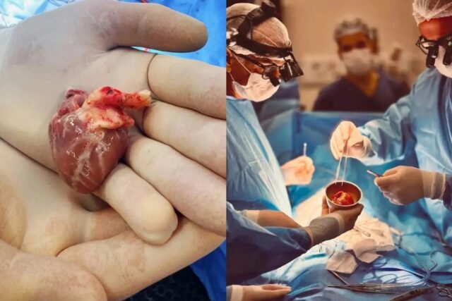 Transplante de Coração